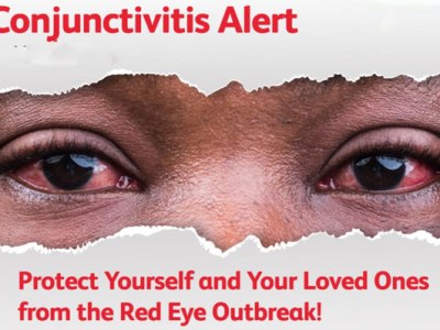 Outbreak Of Red Eye Disease Confirmed In Gulu City Schools